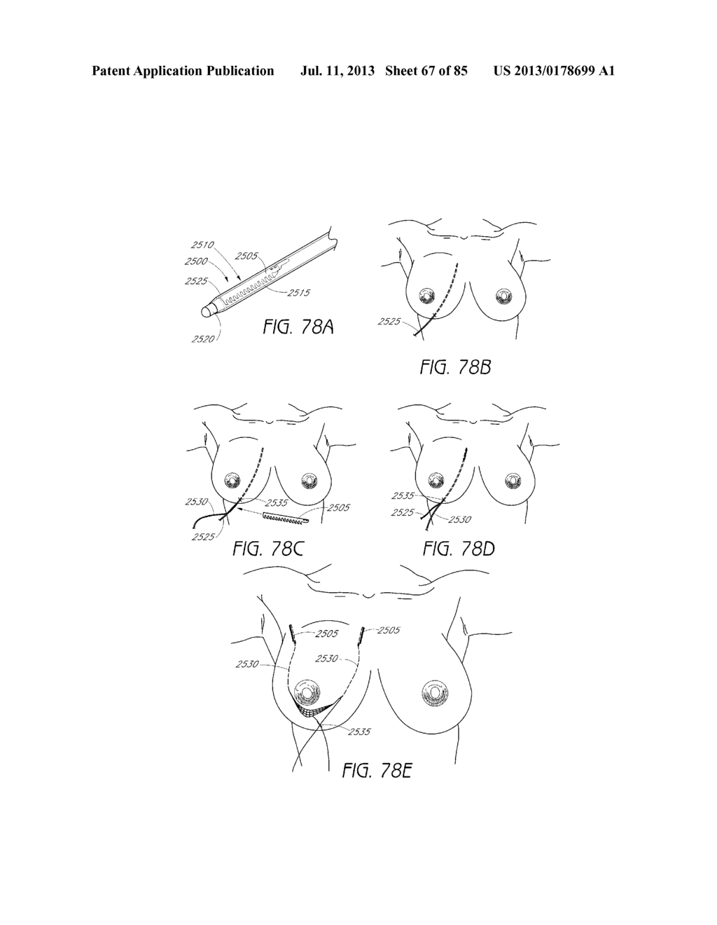 MINIMALLY INVASIVE TISSUE SUPPORT - diagram, schematic, and image 68