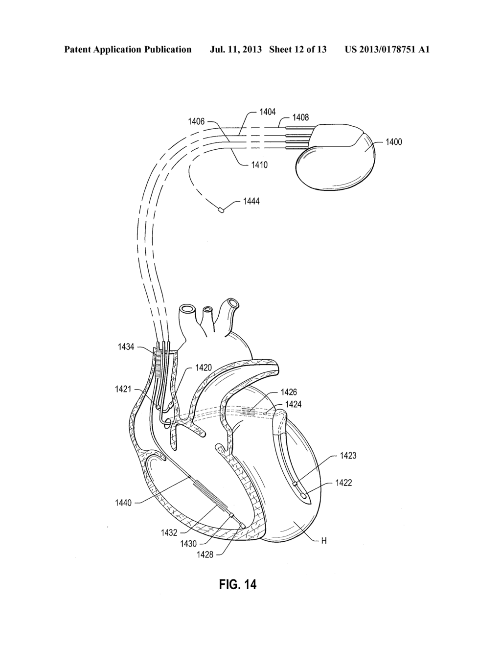 IMPLANTABLE MEDICAL DEVICE FOR MEASURING PRESSURE VIA AN L-C RESONANT     CIRCUIT - diagram, schematic, and image 13