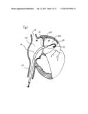 METHODS AND DEVICES FOR INTRA-ATRIAL SHUNTS HAVING ADJUSTABLE SIZES diagram and image