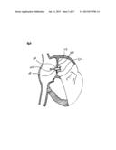 METHODS AND DEVICES FOR INTRA-ATRIAL SHUNTS HAVING ADJUSTABLE SIZES diagram and image