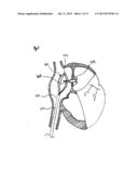 METHODS AND DEVICES FOR INTRA-ATRIAL SHUNTS HAVING ADJUSTABLE SIZES diagram and image