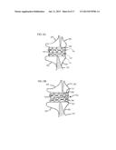 METHODS AND DEVICES FOR INTRA-ATRIAL SHUNTS HAVING ADJUSTABLE SIZES diagram and image