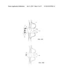 METHODS AND DEVICES FOR INTRA-ATRIAL SHUNTS HAVING ADJUSTABLE SIZES diagram and image