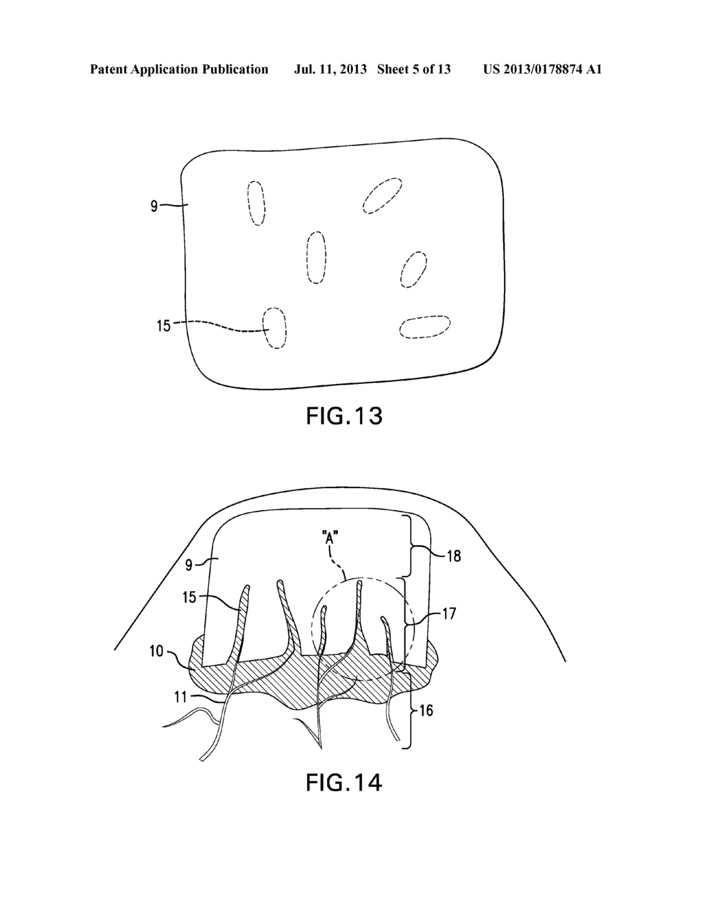 COMPOSITE IMPLANT - diagram, schematic, and image 06