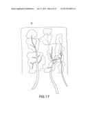 COMPOSITE IMPLANT diagram and image