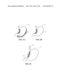 Methods, Instruments and Devices for Extragastric Reduction of Stomach     Volume diagram and image