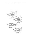 Methods, Instruments and Devices for Extragastric Reduction of Stomach     Volume diagram and image