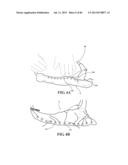 Methods, Instruments and Devices for Extragastric Reduction of Stomach     Volume diagram and image