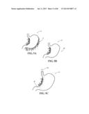 Methods, Instruments and Devices for Extragastric Reduction of Stomach     Volume diagram and image