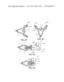 Methods, Instruments and Devices for Extragastric Reduction of Stomach     Volume diagram and image