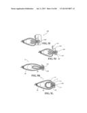 Methods, Instruments and Devices for Extragastric Reduction of Stomach     Volume diagram and image