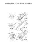 Methods, Instruments and Devices for Extragastric Reduction of Stomach     Volume diagram and image