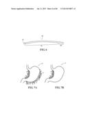 Methods, Instruments and Devices for Extragastric Reduction of Stomach     Volume diagram and image