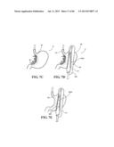 Methods, Instruments and Devices for Extragastric Reduction of Stomach     Volume diagram and image