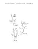 Methods, Instruments and Devices for Extragastric Reduction of Stomach     Volume diagram and image