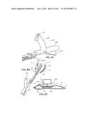 Methods, Instruments and Devices for Extragastric Reduction of Stomach     Volume diagram and image