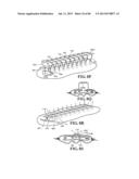 Methods, Instruments and Devices for Extragastric Reduction of Stomach     Volume diagram and image