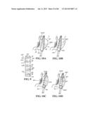 Methods, Instruments and Devices for Extragastric Reduction of Stomach     Volume diagram and image