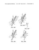 Methods, Instruments and Devices for Extragastric Reduction of Stomach     Volume diagram and image