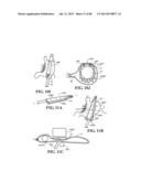 Methods, Instruments and Devices for Extragastric Reduction of Stomach     Volume diagram and image