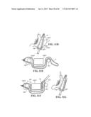 Methods, Instruments and Devices for Extragastric Reduction of Stomach     Volume diagram and image