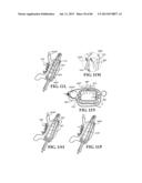 Methods, Instruments and Devices for Extragastric Reduction of Stomach     Volume diagram and image