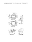 Methods, Instruments and Devices for Extragastric Reduction of Stomach     Volume diagram and image