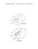 Methods, Instruments and Devices for Extragastric Reduction of Stomach     Volume diagram and image