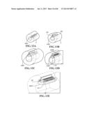 Methods, Instruments and Devices for Extragastric Reduction of Stomach     Volume diagram and image