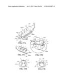 Methods, Instruments and Devices for Extragastric Reduction of Stomach     Volume diagram and image