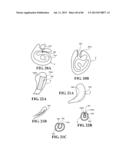 Methods, Instruments and Devices for Extragastric Reduction of Stomach     Volume diagram and image