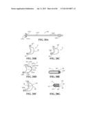 Methods, Instruments and Devices for Extragastric Reduction of Stomach     Volume diagram and image