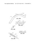 Methods, Instruments and Devices for Extragastric Reduction of Stomach     Volume diagram and image