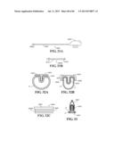 Methods, Instruments and Devices for Extragastric Reduction of Stomach     Volume diagram and image