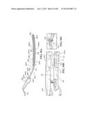 Methods, Instruments and Devices for Extragastric Reduction of Stomach     Volume diagram and image