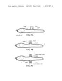 Methods, Instruments and Devices for Extragastric Reduction of Stomach     Volume diagram and image