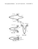 Methods, Instruments and Devices for Extragastric Reduction of Stomach     Volume diagram and image