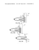 Methods, Instruments and Devices for Extragastric Reduction of Stomach     Volume diagram and image