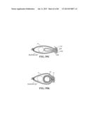 Methods, Instruments and Devices for Extragastric Reduction of Stomach     Volume diagram and image