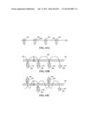 Methods, Instruments and Devices for Extragastric Reduction of Stomach     Volume diagram and image