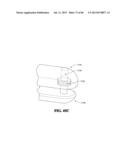 Methods, Instruments and Devices for Extragastric Reduction of Stomach     Volume diagram and image