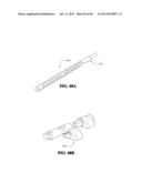 Methods, Instruments and Devices for Extragastric Reduction of Stomach     Volume diagram and image