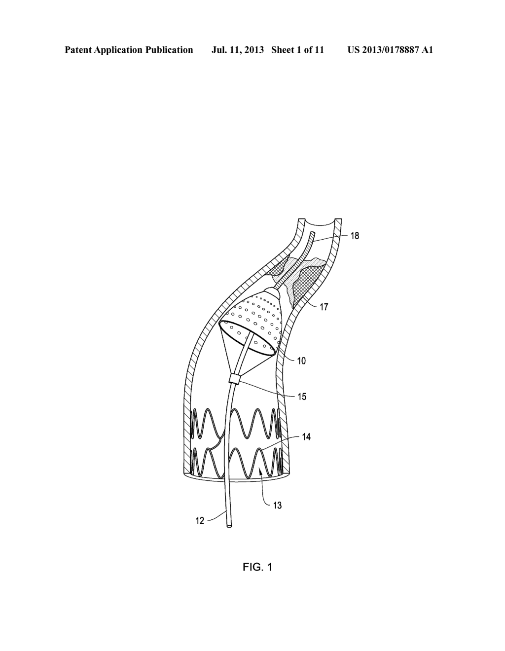 Retrieval Catheters and Methods of Retrieving Deployed Medical Devices - diagram, schematic, and image 02