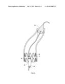 Retrieval Catheters and Methods of Retrieving Deployed Medical Devices diagram and image