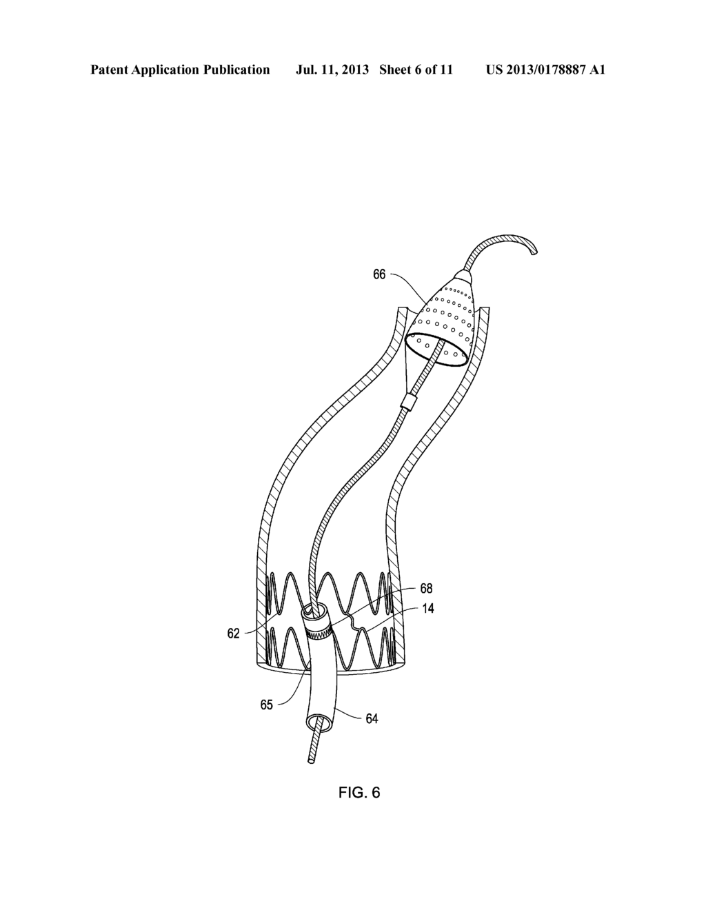 Retrieval Catheters and Methods of Retrieving Deployed Medical Devices - diagram, schematic, and image 07