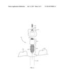 Porous Implants diagram and image