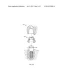 Porous Implants diagram and image