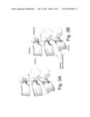 DEVICES AND METHODS TO PREVENT OR LIMIT SPONDLYLOLISTHESIS AND OTHER     ABERRANT MOVEMENTS OF THE VERTEBRAL BONES diagram and image