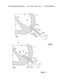 ELECTROPHYSIOLOGICAL ENDOCARDIOLOGY TOOL diagram and image