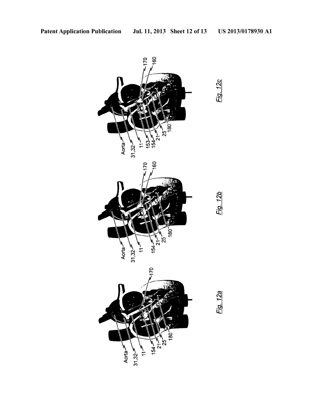 CATHETER SYSTEM FOR INTRODUCING AN EXPANDABLE HEART VALVE STENT INTO THE     BODY OF A PATIENT, INSERTION SYSTEM WITH A CATHETER SYSTEM AND MEDICAL     DEVICE FOR TREATMENT OF A HEART VALVE DEFECT - diagram, schematic, and image 13